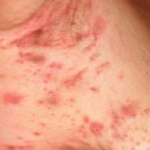 Hidradenitis süppürativa 3