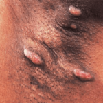 Hidradenitis Suppurativa