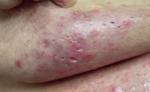 Hidradenitis Evreleri ve Hızlı Tedavisi